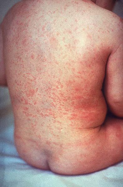 Déclenchement de l’alerte de niveau 2 au Japon suite à l’épidémie de rubéole